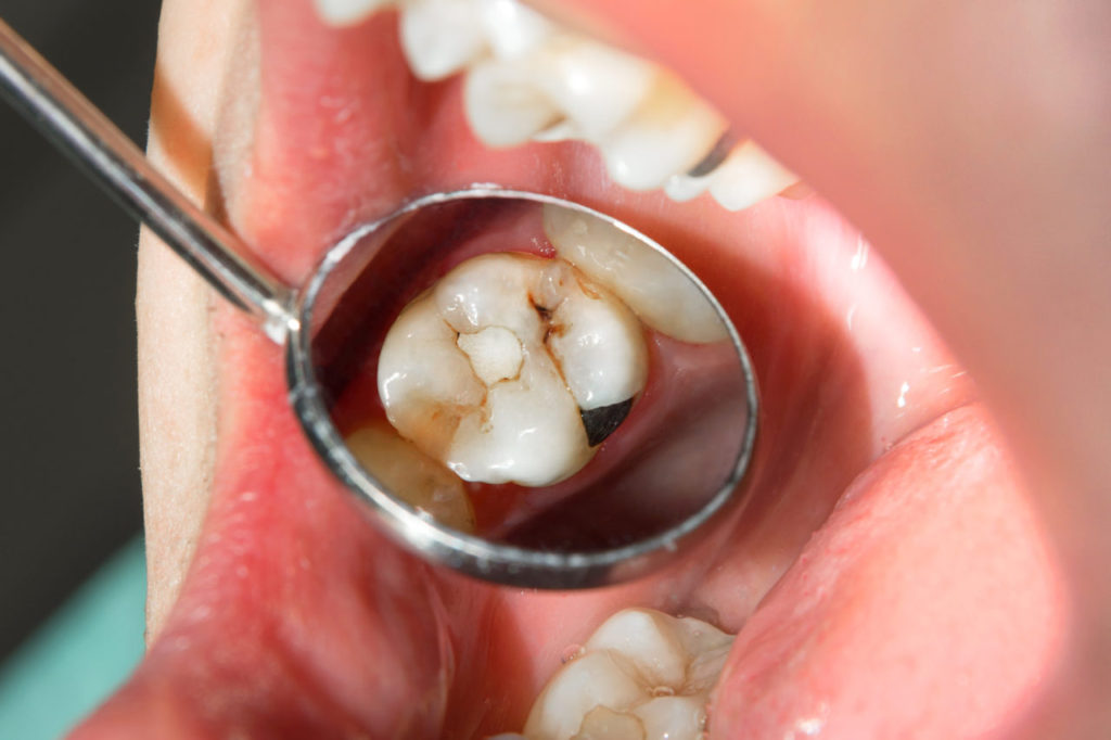 close-up of a human rotten carious tooth at the treatment stage