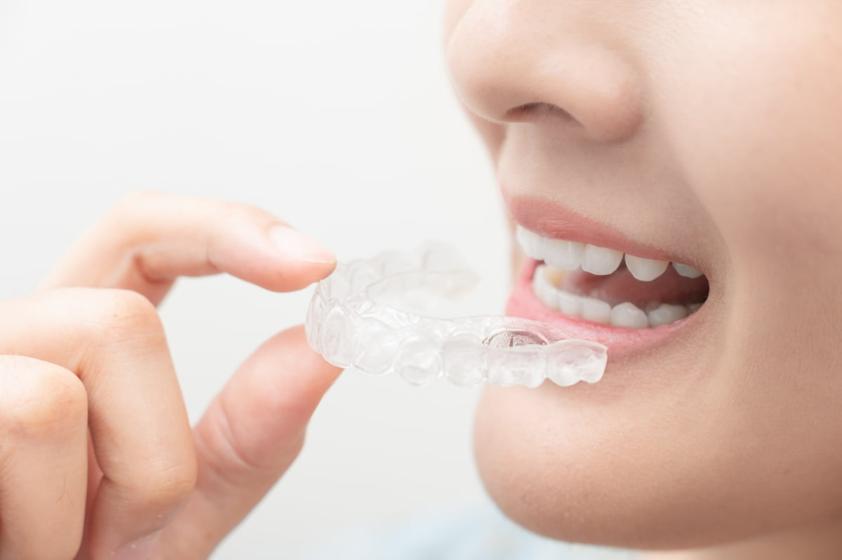 女性がマウスピースを装着する様子