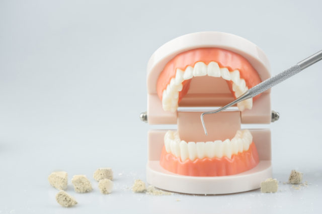 歯石をとるイメージ