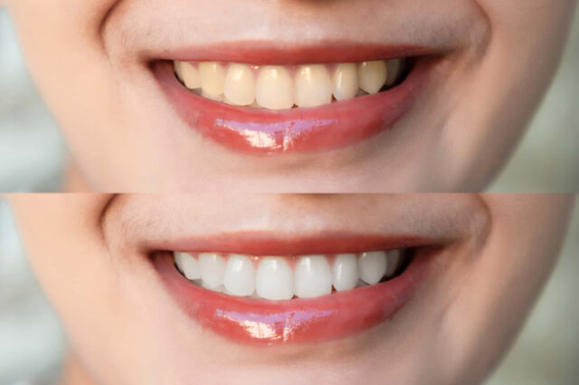 ホワイトニングの前後のイメージ