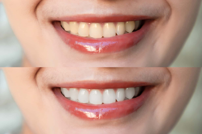ホワイトニングの前後のイメージ