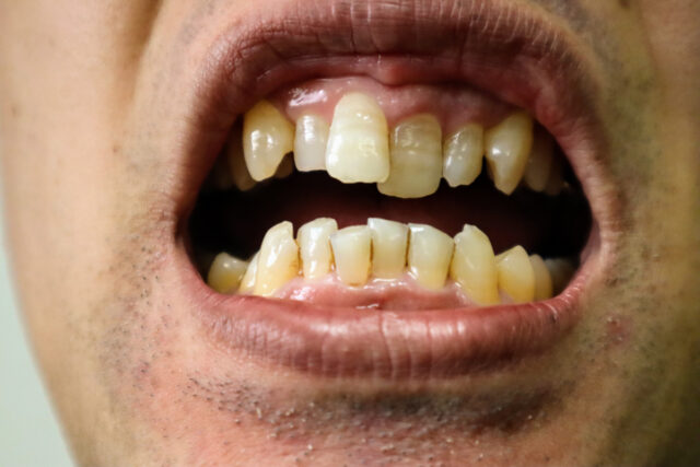 歯並びの悪い男性