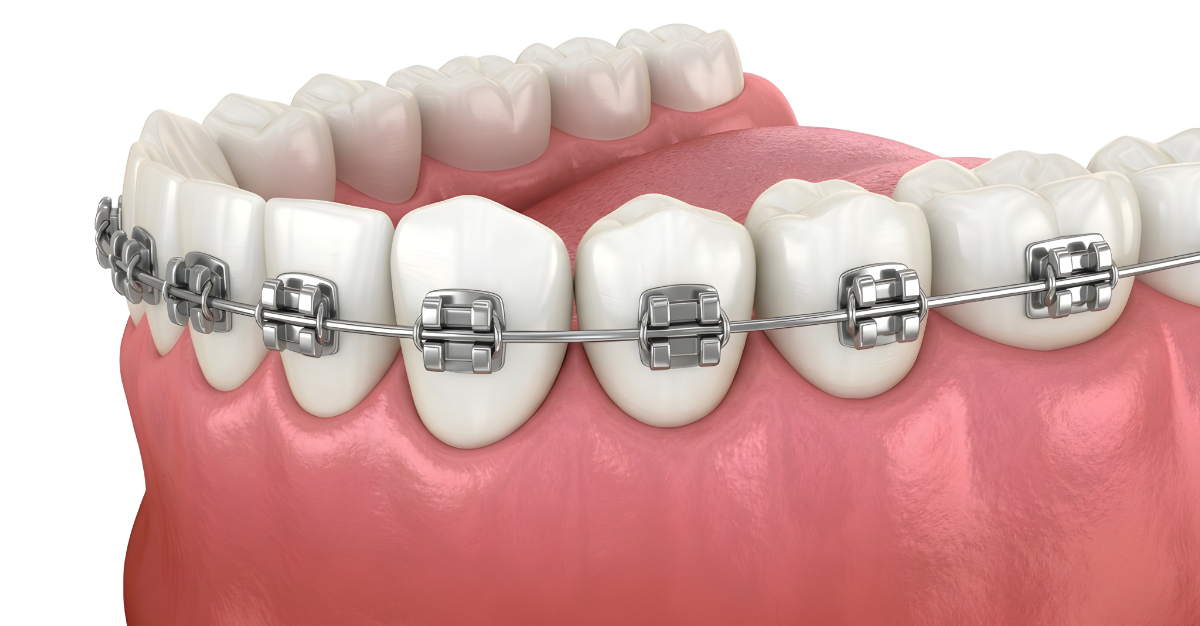 ワイヤー矯正をしている歯